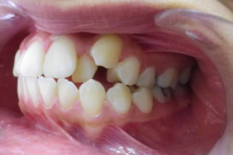 To remove teeth or to not remove teeth…The Irvine Orthodontist’s take
