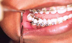 Orthodontic “Oopsies”