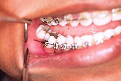 Orthodontic “Oopsies”