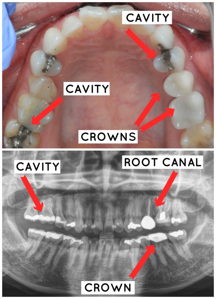 cavities